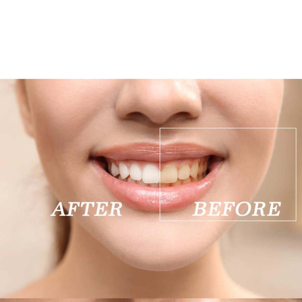 Top Quality Peroxide Teeth Whi - огляд і ціна Teeth Whitening Gels
