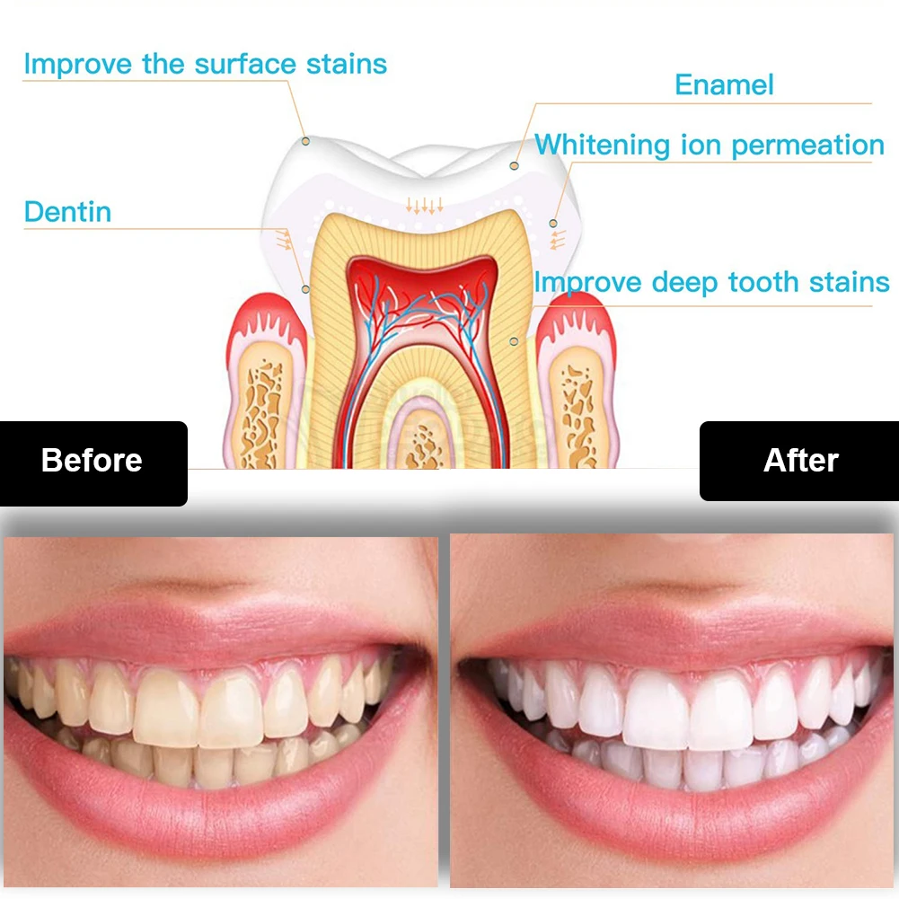 Dental Teeth Whitening Kit Min - огляд і ціна Whitening Pen Bleach