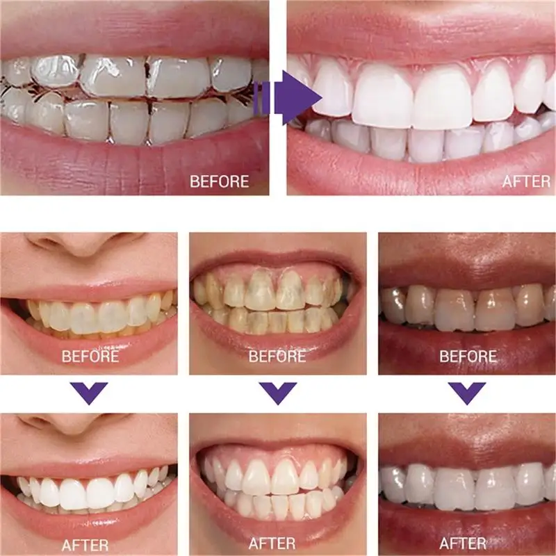 Fast Teeth Whtening Toothpaste - огляд і ціна Whitening Pen Bleach